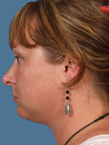 Case # 9 before photo