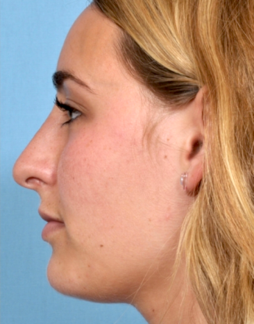 Case # 1 after photo