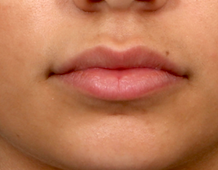 Case # 4 after photo