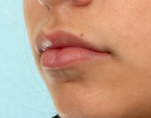 Case # 4 after photo