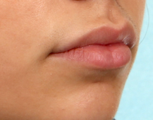 Case # 4 after photo