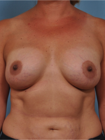 Case # 18 after photo