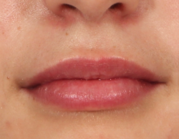 Case # 12 after photo