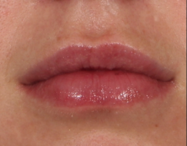 Case # 13 after photo