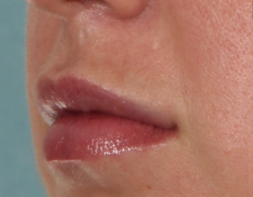 Case # 13 after photo