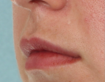 Case # 13 before photo