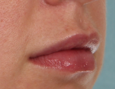 Case # 13 after photo