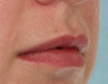 Case # 13 before photo