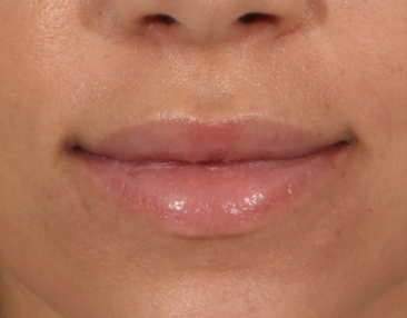 Case # 15 after photo