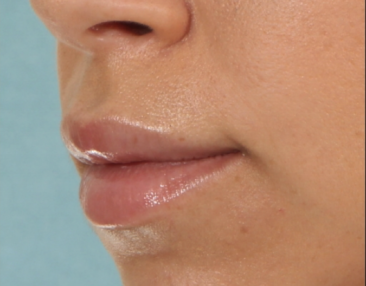 Case # 15 after photo