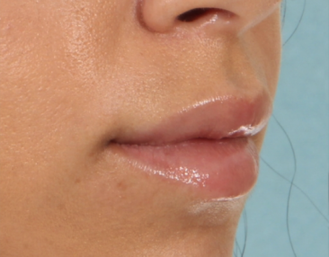 Case # 15 after photo