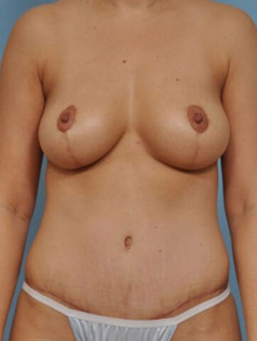 Case # 6 after photo