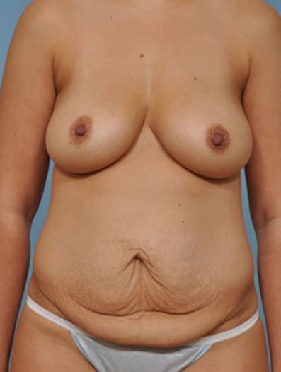 before and after gallery image