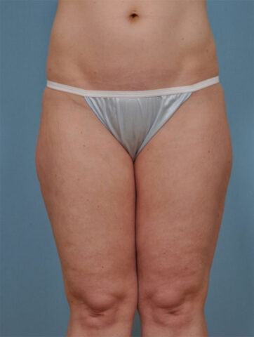 Case # 5 after photo