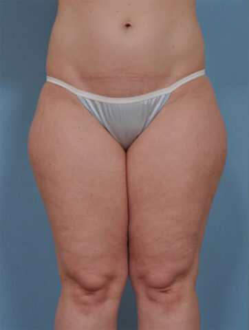 Case # 5 before photo