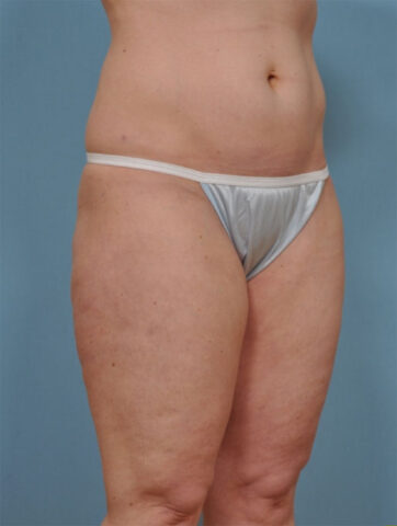 Case # 5 after photo