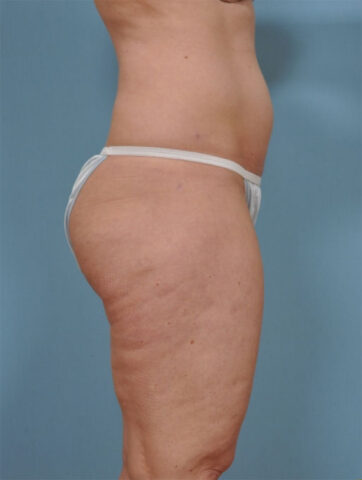 Case # 5 after photo