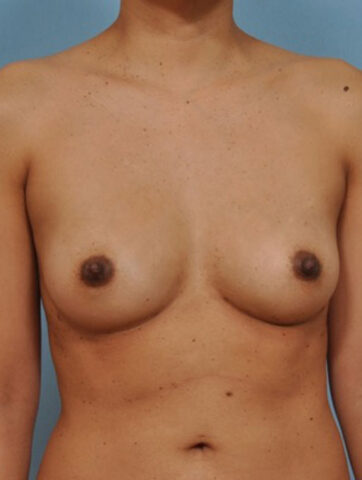 Case # 5 after photo