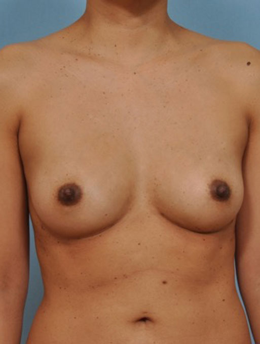 before and after gallery image
