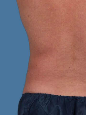 Case # 12 after photo