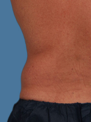 Case # 12 before photo