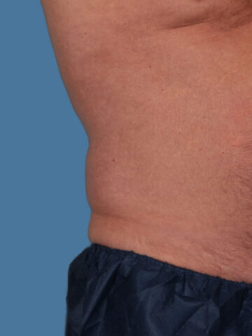 Case # 12 after photo