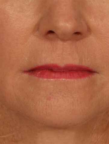 Case # 19 after photo