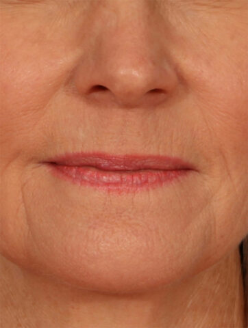 Case # 19 before photo