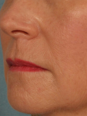 Case # 19 after photo