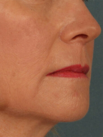 Case # 19 after photo