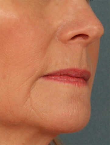 Case # 19 before photo