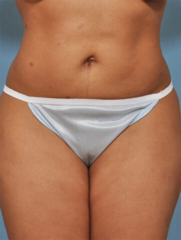 Case # 4 after photo