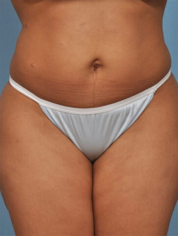 Case # 4 before photo