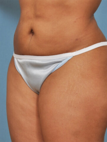 Case # 4 after photo