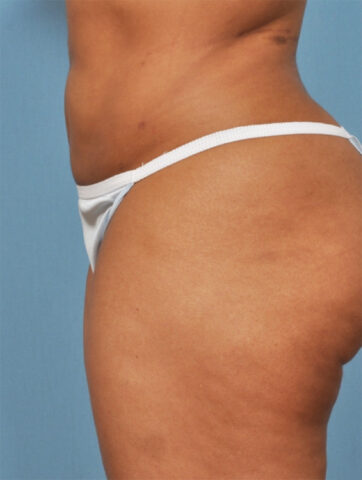 Case # 4 after photo