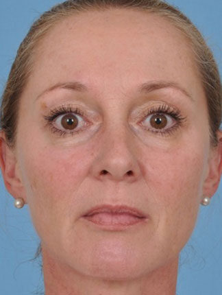 Case # 18 after photo