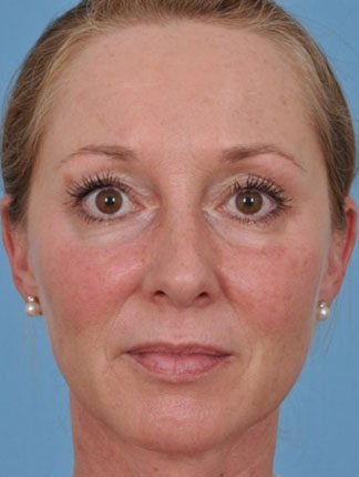 Case # 18 before photo