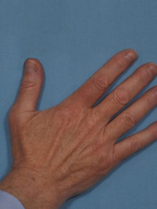 Case # 17 after photo