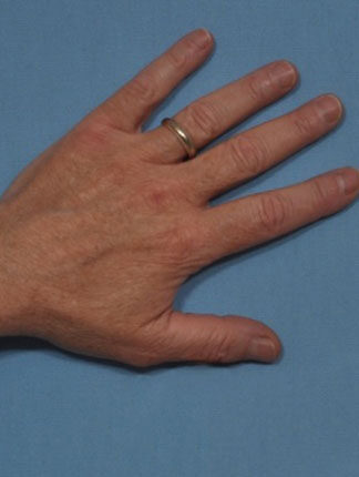 Case # 17 after photo