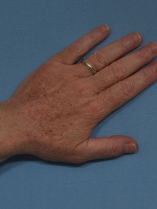 Case # 17 before photo