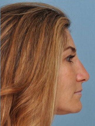 Case # 5 after photo