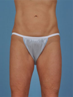 Case # 2 after photo