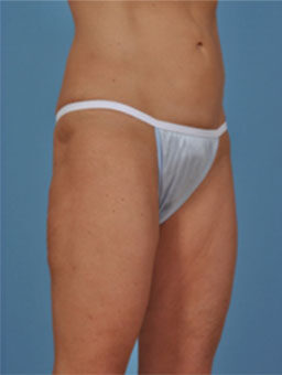 Case # 2 after photo