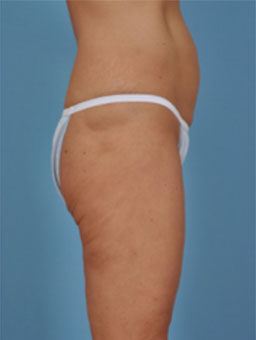 Case # 2 after photo