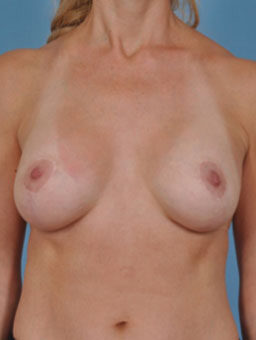 Case # 10 after photo