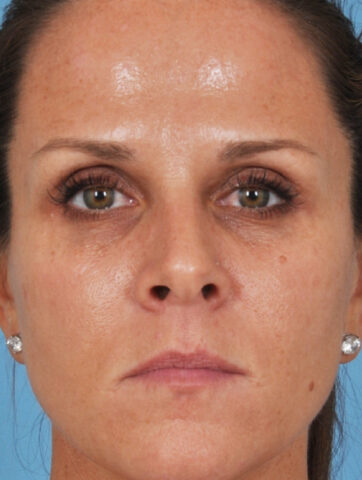 Case # 10 after photo