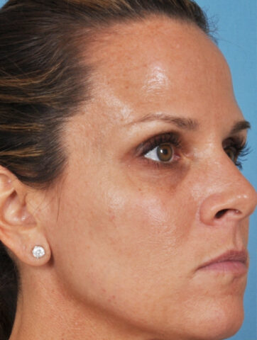 Case # 10 after photo