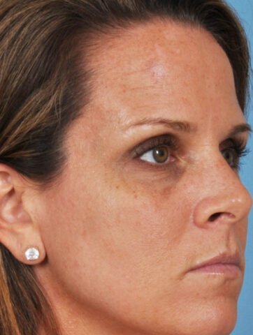 Case # 10 before photo