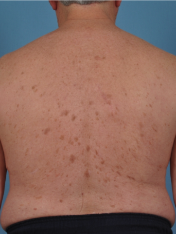 Case # 5 after photo