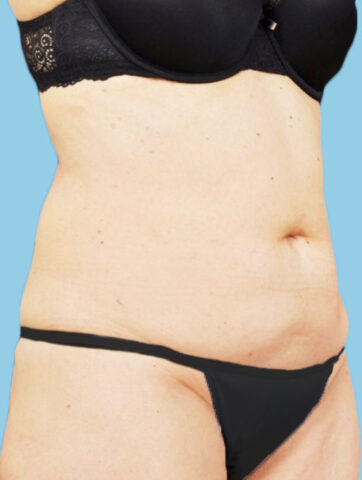 Case # 8 before photo